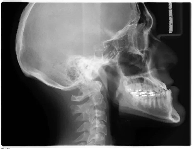 CBCT IN THE EVALUATION OF AIRWAY — MINIMIZING ORTHODONTIC RELAPSE