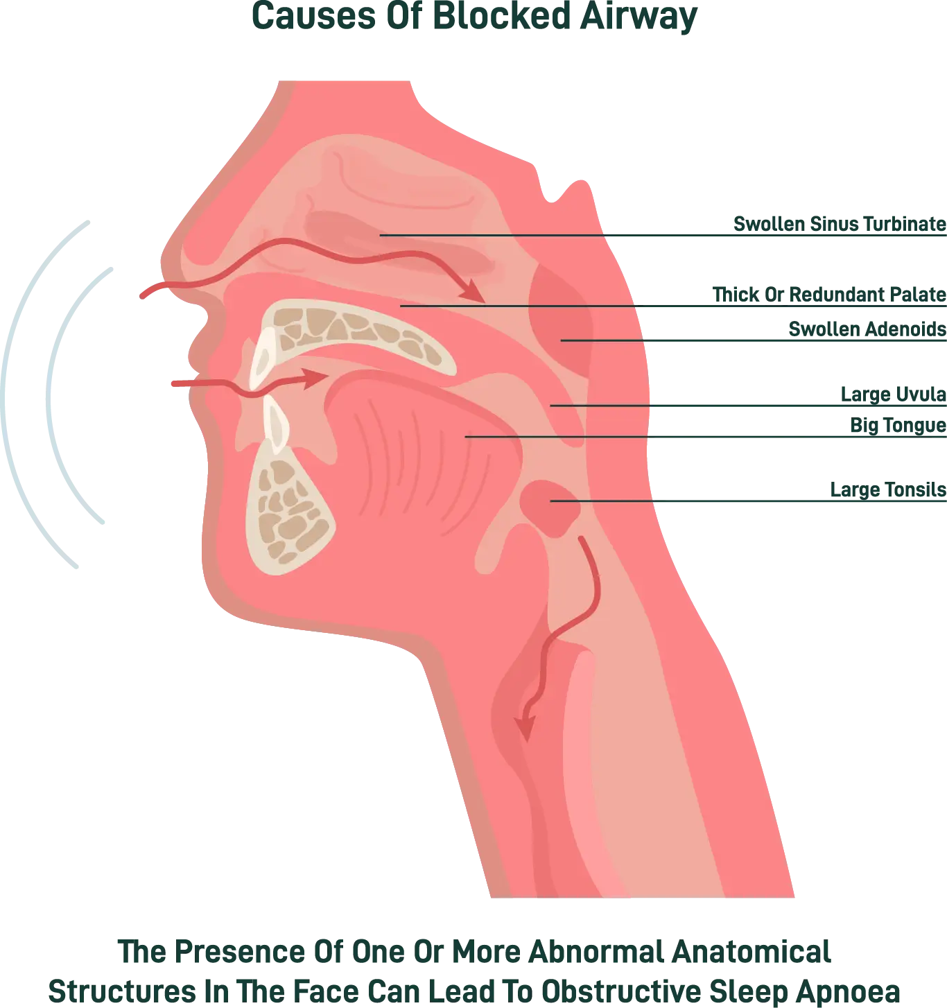 Airway and snoring infographic