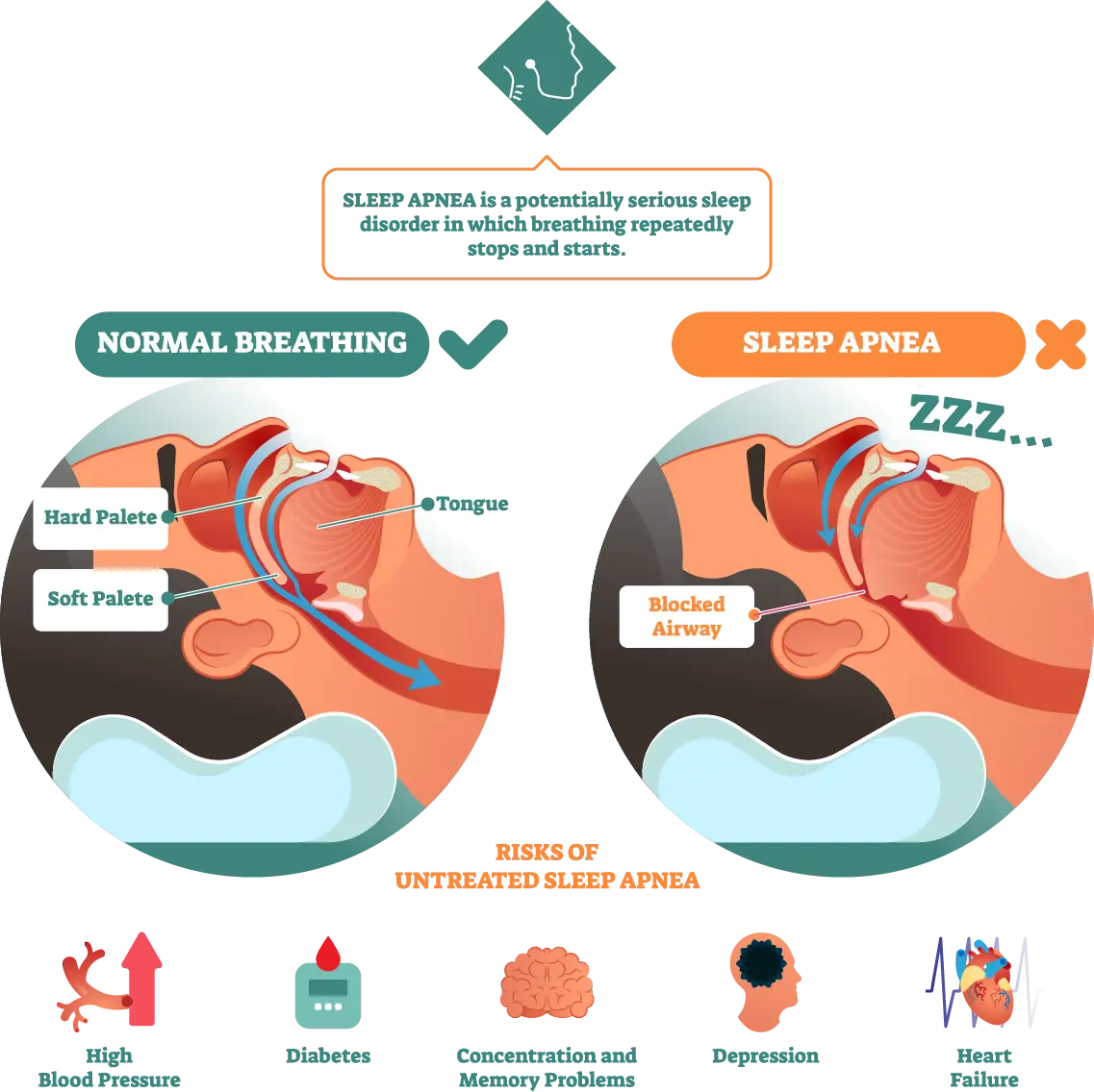Sleep Apnea Infographic