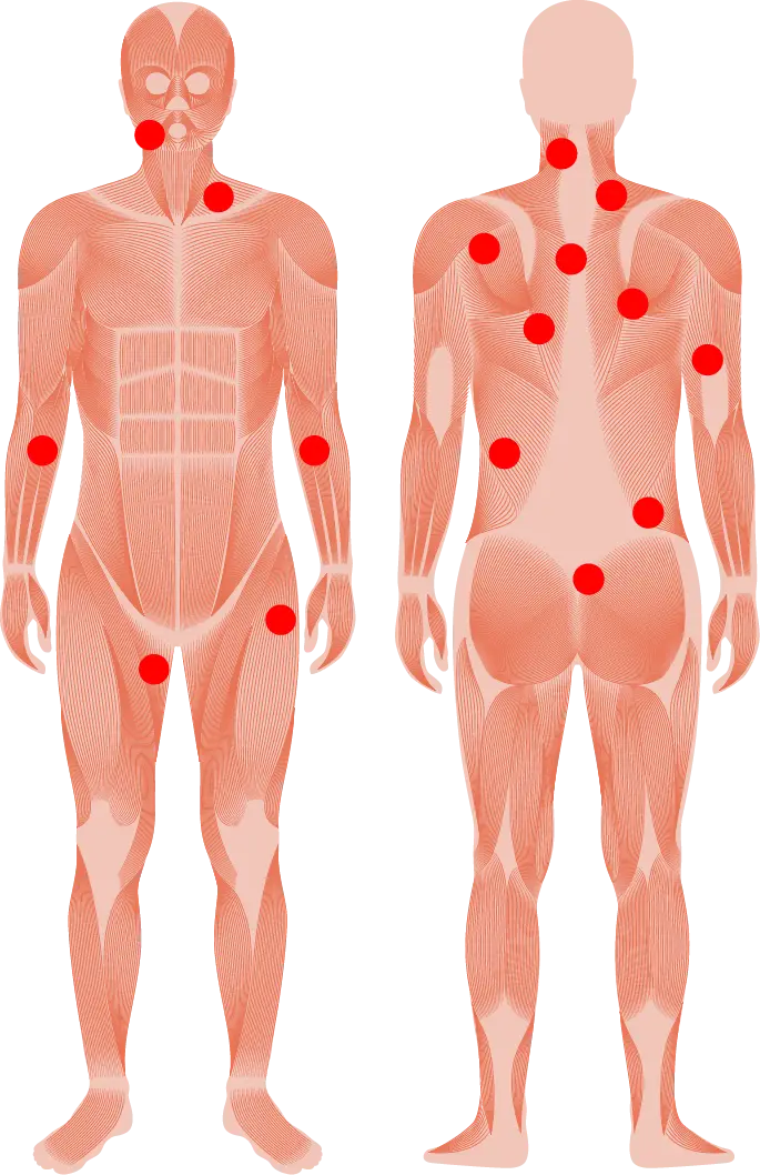 About Trigger Points About Trigger Points